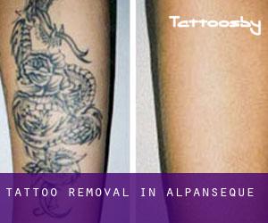 Tattoo Removal in Alpanseque