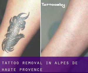 Tattoo Removal in Alpes-de-Haute-Provence