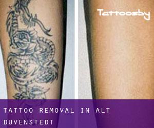 Tattoo Removal in Alt Duvenstedt