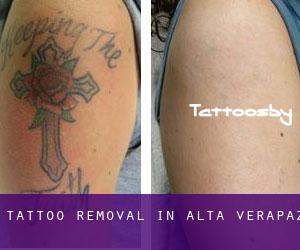 Tattoo Removal in Alta Verapaz