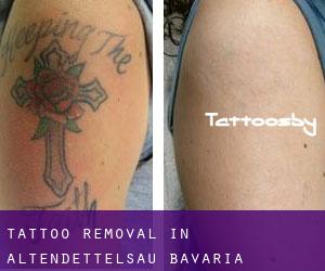 Tattoo Removal in Altendettelsau (Bavaria)