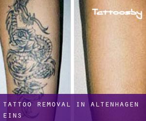 Tattoo Removal in Altenhagen Eins
