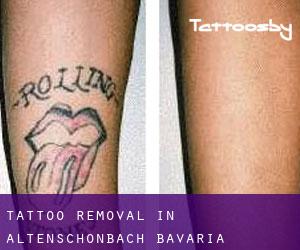 Tattoo Removal in Altenschönbach (Bavaria)