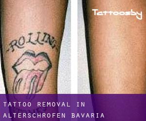 Tattoo Removal in Alterschrofen (Bavaria)