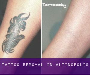 Tattoo Removal in Altinópolis