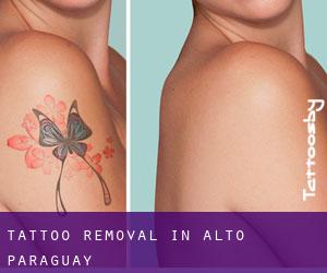 Tattoo Removal in Alto Paraguay