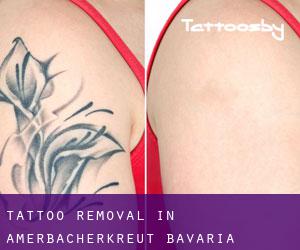 Tattoo Removal in Amerbacherkreut (Bavaria)