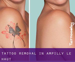 Tattoo Removal in Ampilly-le-Haut