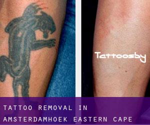 Tattoo Removal in Amsterdamhoek (Eastern Cape)