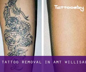 Tattoo Removal in Amt Willisau