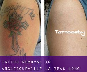 Tattoo Removal in Anglesqueville-la-Bras-Long