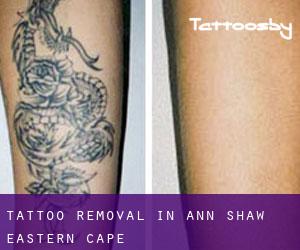 Tattoo Removal in Ann Shaw (Eastern Cape)