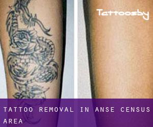 Tattoo Removal in Anse (census area)