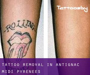 Tattoo Removal in Antignac (Midi-Pyrénées)