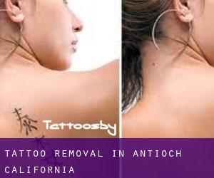 Tattoo Removal in Antioch (California)