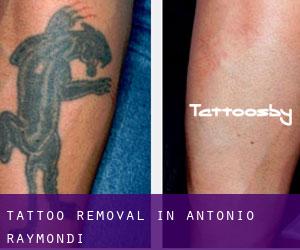 Tattoo Removal in Antonio Raymondi
