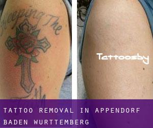 Tattoo Removal in Appendorf (Baden-Württemberg)