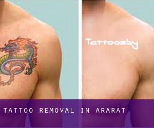 Tattoo Removal in Ararat