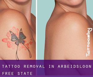 Tattoo Removal in Arbeidsloon (Free State)