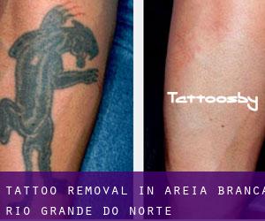 Tattoo Removal in Areia Branca (Rio Grande do Norte)