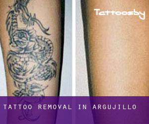 Tattoo Removal in Argujillo