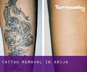 Tattoo Removal in Arija