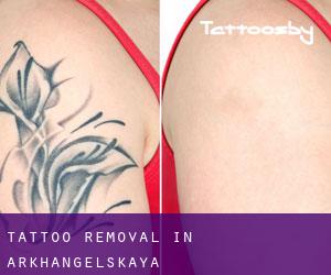 Tattoo Removal in Arkhangelskaya
