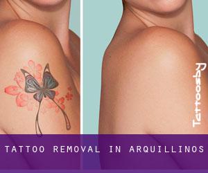 Tattoo Removal in Arquillinos