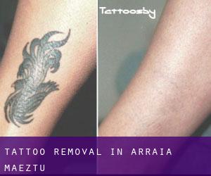 Tattoo Removal in Arraia-Maeztu