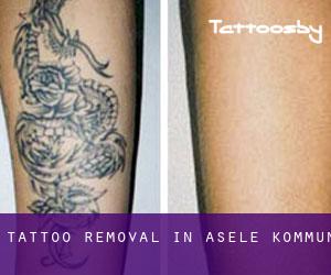 Tattoo Removal in Åsele Kommun