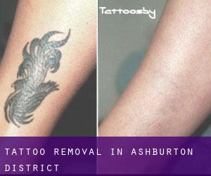 Tattoo Removal in Ashburton District