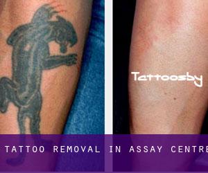 Tattoo Removal in Assay (Centre)