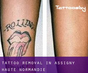 Tattoo Removal in Assigny (Haute-Normandie)