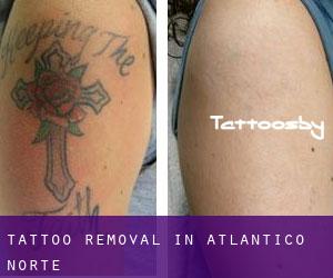 Tattoo Removal in Atlántico Norte