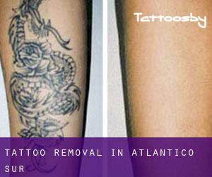 Tattoo Removal in Atlántico Sur
