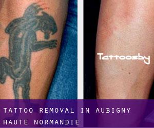 Tattoo Removal in Aubigny (Haute-Normandie)