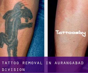 Tattoo Removal in Aurangabad Division
