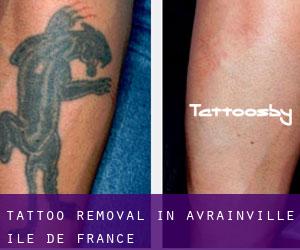 Tattoo Removal in Avrainville (Île-de-France)