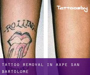 Tattoo Removal in Axpe-San Bartolome