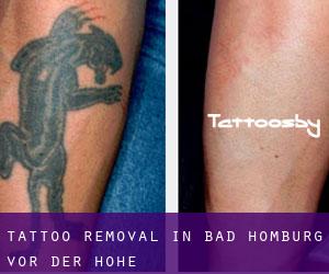 Tattoo Removal in Bad Homburg vor der Höhe