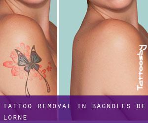 Tattoo Removal in Bagnoles-de-l'Orne