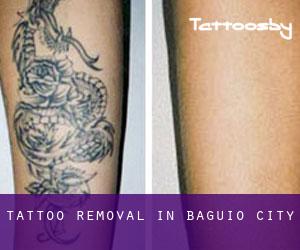 Tattoo Removal in Baguio City