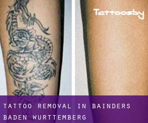 Tattoo Removal in Bainders (Baden-Württemberg)