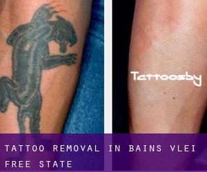 Tattoo Removal in Bain's Vlei (Free State)