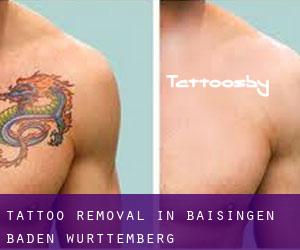 Tattoo Removal in Baisingen (Baden-Württemberg)