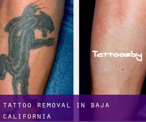 Tattoo Removal in Baja California