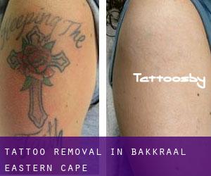 Tattoo Removal in Bakkraal (Eastern Cape)