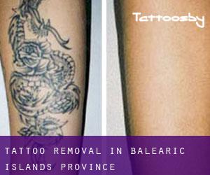 Tattoo Removal in Balearic Islands (Province)