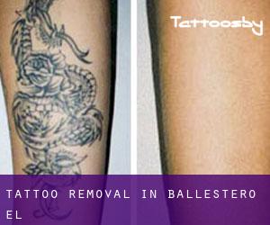 Tattoo Removal in Ballestero (El)