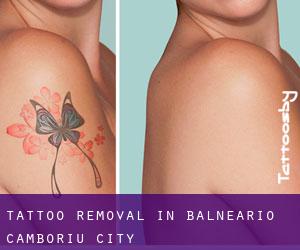 Tattoo Removal in Balneário Camboriú (City)